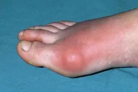 消除痛风石只能做手术嘛？医生告诉你别走弯路，这个药也可以。图片