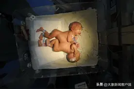 因爱分离 14年后回访连体女婴丨面孔图片