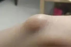 手背突然长个包，虽然不痛也不痒，摸着心里怪别扭图片