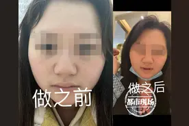 南昌：女子贷款整容，结果抑郁了！工作人员：医生发挥失常图片