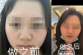 南昌：女子贷款整容，结果抑郁了！工作人员：医生发挥失常图片