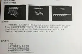 从8个维度，帮你严格判断甲状腺结节的良恶性图片