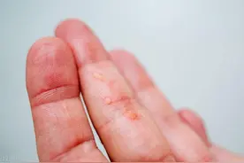 夏天手上长出奇痒无比的“小水泡”怎么办？图片