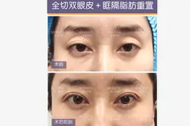 「北京双眼皮修复案例」双眼皮修复＋上睑提肌＋眶隔脂肪重置图片