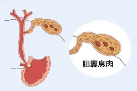 胆囊息肉，最怕出现这3种情况，容易诱发恶变，很多患者都忽视了图片