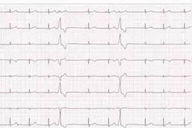 10岁女童心律失常，检查有无心脏功能异常很重要（上）图片