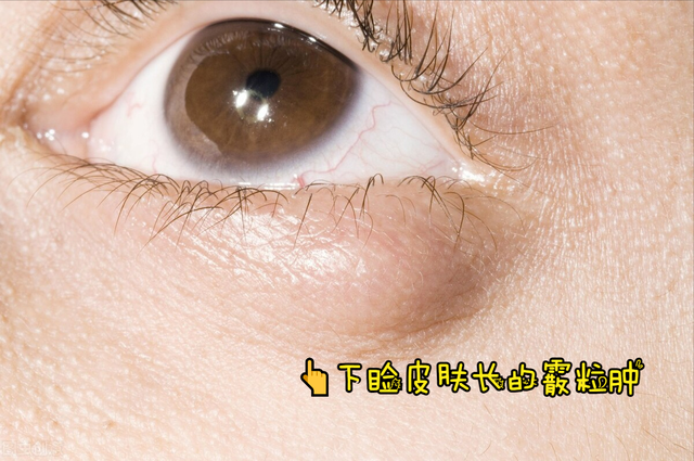 眼皮上长小疙瘩要注意什么？