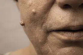 夺走赵忠祥生命的「鳞状细胞癌」，听起来陌生，实际上并不少见图片