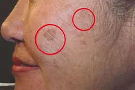 人为何会长老人斑？红霉素软膏能去除掉老人斑吗？看后涨知识了图片