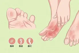 手足癣何时了？正确应对最重要！手足癣的中医辨证治疗图片