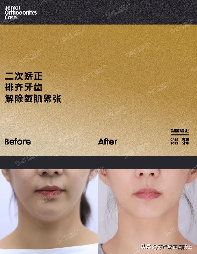 正颌手术后前突后缩依旧!兜兜转转,最后还是选择了矫正