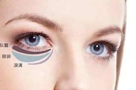 眼袋是怎么形成的，去除后要注意哪些事项图片