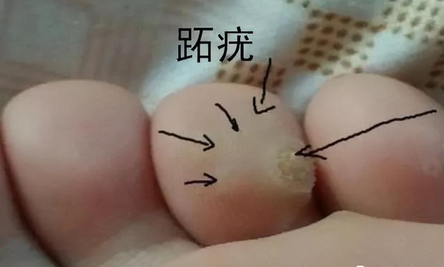 长了鸡眼怎么办，怎么治疗好？