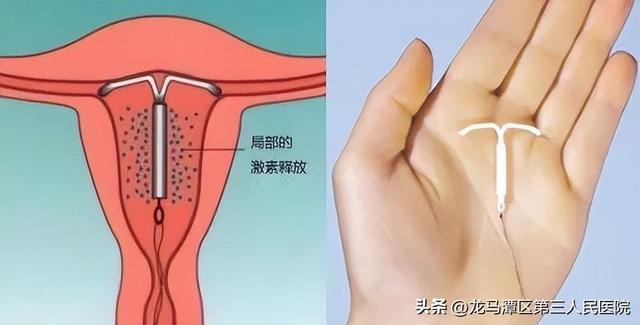 【妇科科普】安环取环痛不痛？什么时候需要取环？