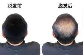 “秃”然没了，中年男人绕不过的坎！图片