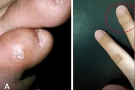 看图，猜猜哪个是鸡眼图片