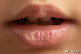 嘴唇起皮越舔越干，越干越想舔？该怎么办？这种情况一招解决图片