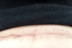 剖腹产如何预防难看的疤痕？图片