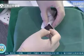 微创切口下取葡萄核 看外科医生“十八般武艺”如何炼成图片