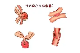 “世事无常，大肠包小肠”：肠套叠治疗切记这一黄金时间期！图片