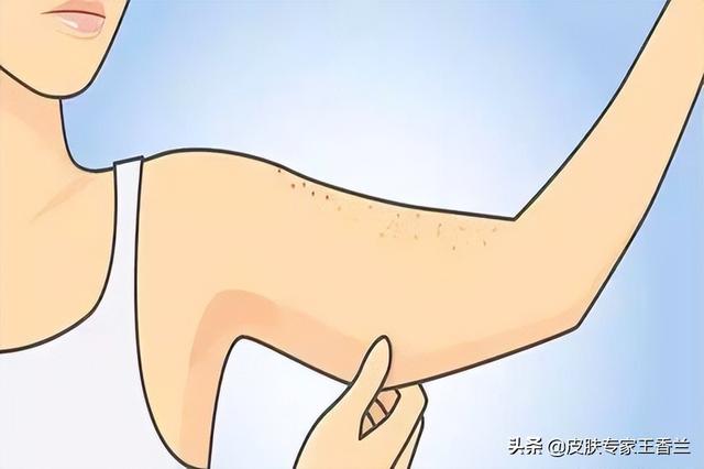 去医院皮肤病看鸡皮