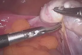 宫颈松弛导致2次晚期流产和继发不孕，治疗后不一连分娩三宝图片