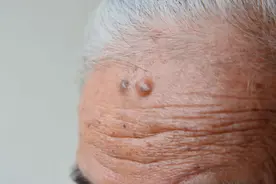 皮肤上出现的“肉疙瘩”是什么？是否会引起癌变？一文给你科普图片