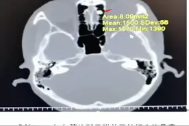 老人头疼2年竟是鼻窦骨瘤所致图片
