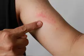 神经性皮炎和癣的区别图片