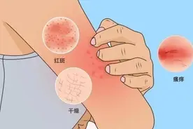 湿疹的原因元凶原来是它，祛除它常见的几种方法！图片