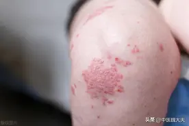 奇痒难忍！男孩17年没睡过一个整觉！特应性皮炎到底是什么？图片