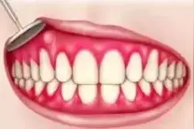 「口腔科普」牙龈鼓起脓包，是上火了吗？图片