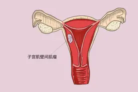 女性为什么容易长子宫肌瘤？得了子宫肌瘤的人，往往有3个难堪图片