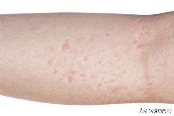 喝酒手臂上长很多鸡皮肤