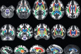 精神分裂症有可能痊愈吗？终于有专家说了实话图片