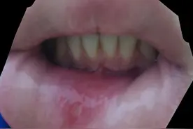 口腔溃疡，多是脾胃虚弱，送你一盒中成药，健脾养胃，赶走溃疡图片