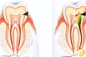 每天认真刷牙，牙齿仍然酸痛？泗泾医院口腔科医生为您解惑……图片