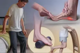 足底筋膜炎的康复治疗图片