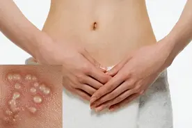 预防男性生殖器部位的4种皮肤病图片