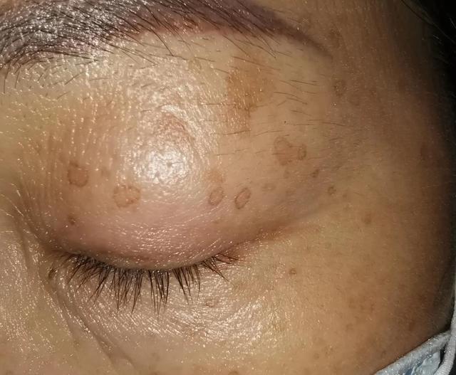 汗孔角化症痒用什么药