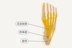 足底筋膜炎有6大原因，图解教你缓解疼痛图片