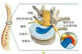 腰椎间盘脱出症及手术记录（十四）图片