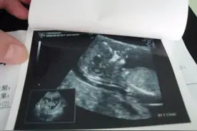 孕期B超惊现脉络丛！到底是啥玩意儿？图片