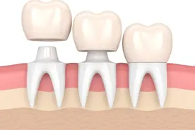 什么是临时牙？为什么要做临时牙？图片
