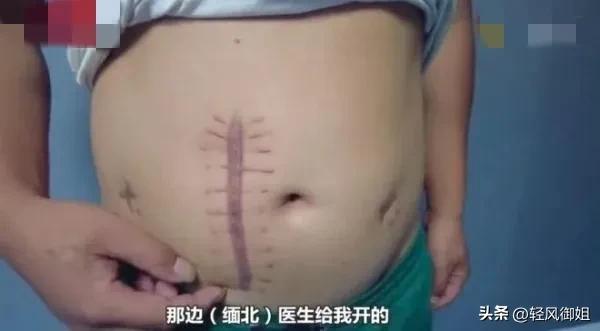 不要去缅北！诈骗卖淫割腰子有去无回，幸存者讲述生不如死的经历