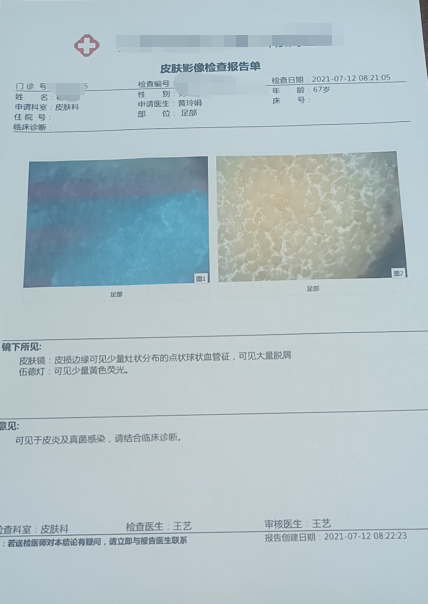鳞屑角化型脚气可以用盐酸特比萘芬乳膏吗