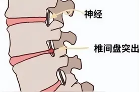 得了“腰突”，坐不住，睡不香，吃药管用吗？图片