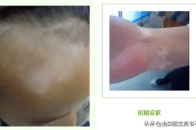 警惕！这4种信号是白癜风的初期症状，快来自测！图片