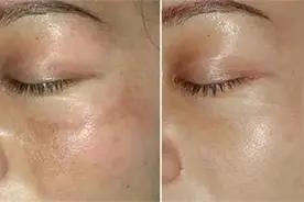 激光美白祛斑，真的管用吗？图片