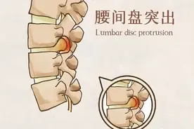 【创建省级卫生城】县中医院骨科微创治疗颈、腰椎间盘突出症图片